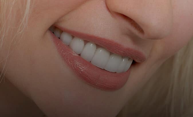 Lower half of a woman's smiling face, close up of her whitened teeth