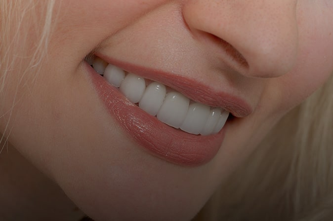Lower half of a woman's smiling face, close up of her whitened teeth