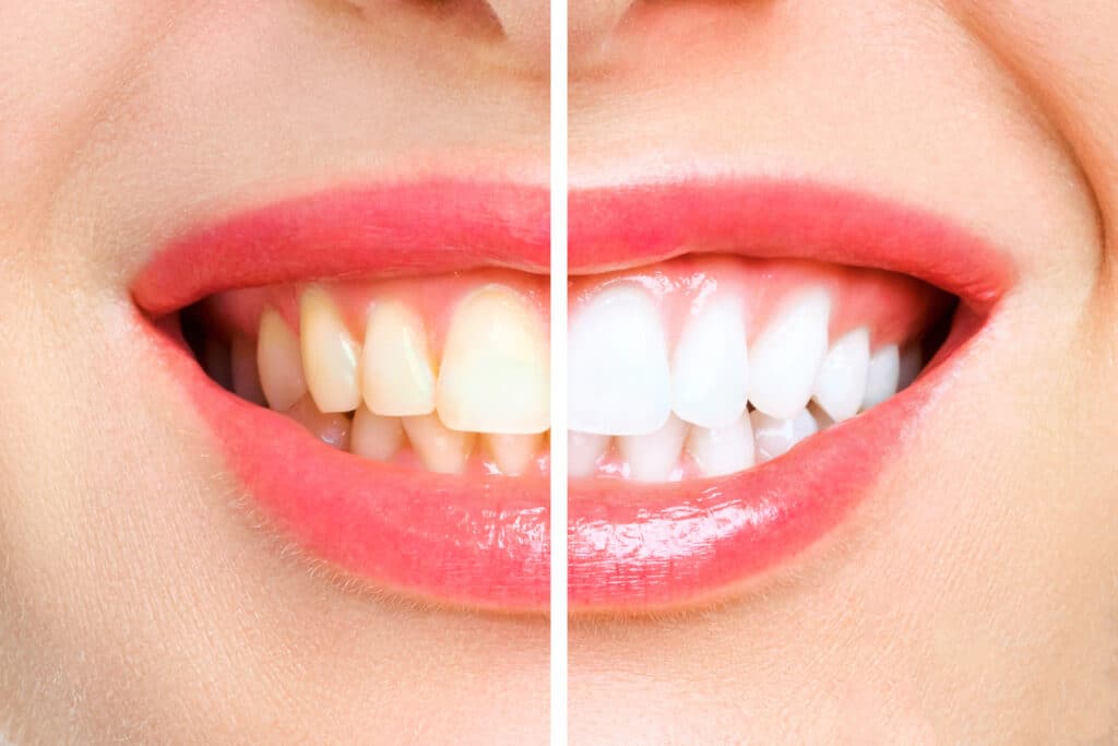 Teeth whitening comparison